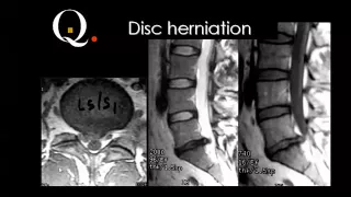 Spine imaging Radiology quiz   Prof Dr  Mamdouh Mahfouz In Arabic 720p