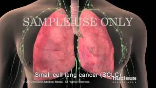 Small Cell Lung Cancer Staging