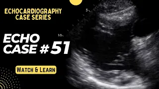 Echocardiography Case 51: Echo Spot Diagnosis - Congenital Heart Disease - Pediatric Cardiology