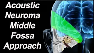 Middle Fossa Approach to Acoustic Neuroma Surgical Removal