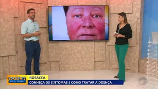 Rosácea é o problema de pele no rosto que se confunde com acne