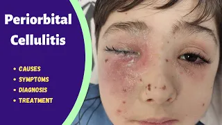 Eyelid infection | Periorbital cellulitis