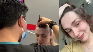Female hair transplant result - Hairline and forehead correction with hair transplant