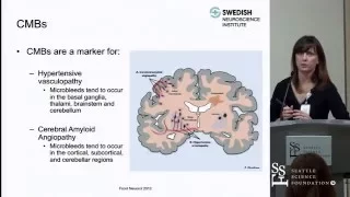 Cerebral Microbleeds, Cerebral Amyloid Angiopahthy and Their Clincial Relevance by Sheila Smith, MD