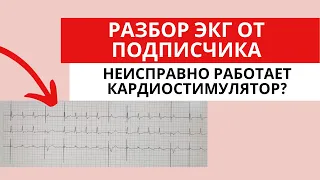 Разбор ЭКГ от подписчика. Исправно ли работает кардиостимулятор?