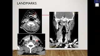 CT IMAGING FOR CERVICAL LYMPHNODES - Dr Kajari Bhattacharya