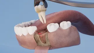 Molar tooth extraction 3D Animation - Autodesk Maya