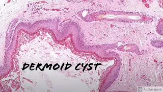 Dermoid Cyst: 5-Minute Pathology Pearls