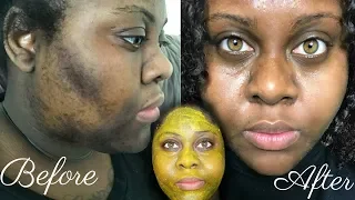 5 DAY TURMERIC FACE MASK CLEARED MY HYPERPIGMENTATION (IM SHOOK)