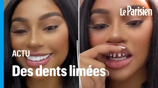 «Il aura un dentier à 30 ans» : la tendance des dents limées inquiète les dentistes