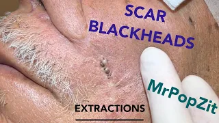 Giant blackheads imbedded in scar tissue extracted. Common occurrence with surgical procedures.