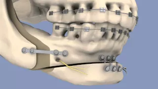 BSSO & Osseous Genioplasty