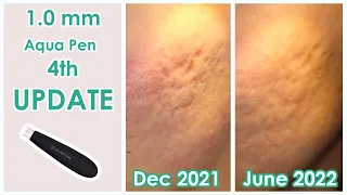 1.0mm Microneedling 4th Update!