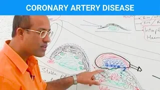 Coronary Artery Disease | Ischemic Heart Disease | Angina🫀