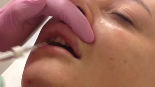АирисКом, студенты учатся: Коррекция верхней губы филлером при наличии ШРАМА и РУБЦОВОЙ ткани.