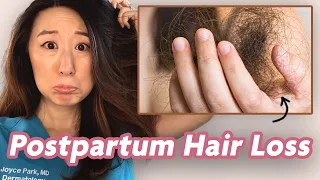 Why Is My Hair Falling Out? Postpartum Hair Loss Explained by Dermatologist Dr. Joyce Park