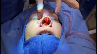 Rhinoplasty (Nose Job) with Septoplasty (Contains Graphic Surgery Scenes)
