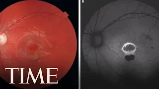 A Laser Pointer Burned A Hole In A 9-Year-Old Boy's Eye, Doctors Say | TIME