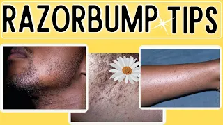 How to Get rid of Razor Bumps| Ingrown hairs