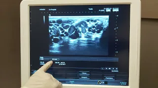 Physical and Doppler Ultrasound examination of High Grade (Grade 3) Varicocele