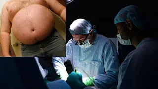 ЭТО КОШМАР! Столичные хирурги удалили из живота пациента 50-килограммовую опухоль