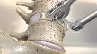 STALIF M™ (MIDLINE II) Surgical Technique Animation | Anterior Lumbar Interbody Fusion