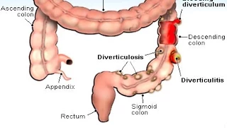 Diverticulitis