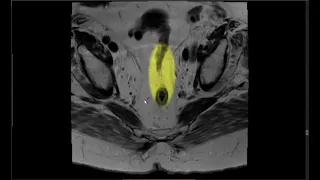 Rectal Cancer Anatomy - MRI Online