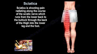 Sciatica, what is causing it and how to treat it