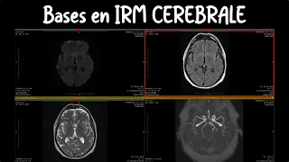 Les indispensable en IRM cérébrale pour l'EDN ( principes d'interprétation pour tout médecin )