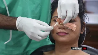 Broad Nose Girl Rhinoplasty - Nose Job Before & After Surgery | Rhinoplasty in India