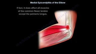 Medial Epicondylitis - Everything You Need To Know - Dr. Nabil Ebraheim