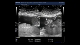 Ultrasound Video showing Anencephaly - a neural tube defect.