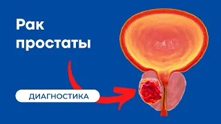 Симптомы рака предстательной железы и методы диагностики