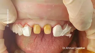 Emax Crown Cementation #dentist #dentistry #dental #cosmeticdentistry