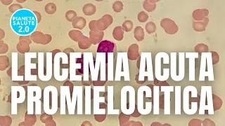 GIMEMA: svolta Trattamento Leucemia Acuta Promielocitica grazie a Ricerca Italiana