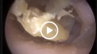 902 - Fully Occluding Keratin Plug Peeled and Removed