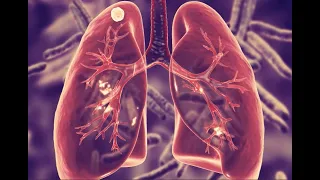 Everything you need to know about a LUNG NODULE, in 6 minutes