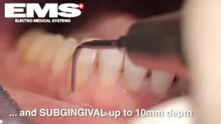 Piezon Instrument PS, sub- and supragingival scaling & root debridement