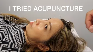 COME WITH ME! TRYING ACUPUNCTURE FOR THE FIRST TIME | Thefabzilla