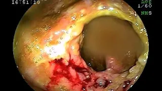 01072019 Colonoscopy for Inflammatory Bowel Disease with ileocecal stricture