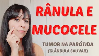 O que é mucocele e rânula? Tumor na Parótida (glândula salivar)