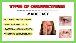 Types of conjunctivitis, Allergic conjunctivitis, Bacterial conjunctivitis, Viral conjunctivitis