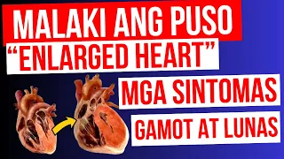 ENLARGED HEART / Lumalaki ang PUSO - Mga Sintomas, Gamot at LUNAS | Cardiomegaly, Heart Failure