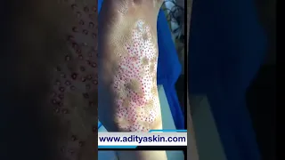 VITILIGO SURGERY | white spot surgery | DR PRIYANK SEN | Vadodara | सफ़ेद दाग इलाज सर्जरी .