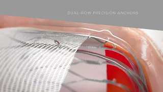 WATCHMAN FLX Device Animation: Implant Technique