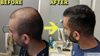 He REVERSED Hair Loss With THIS Simple Hair Loss Treatment Regimen! INCREDIBLE Results!