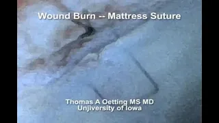 Horizontal Mattress Suture