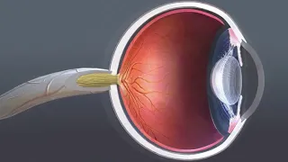(Audio Description) Animation: Cataract