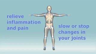 What are the treatments for rheumatoid arthritis?